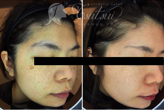 ゼオスキンとは？使う前に是非知っておきたい効果や使い方をポイント